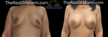Before-and-after views for Breast Augmentation, Case 87.