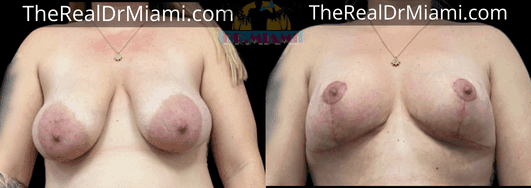 Before-and-after views for Breast Lift, Case 51.