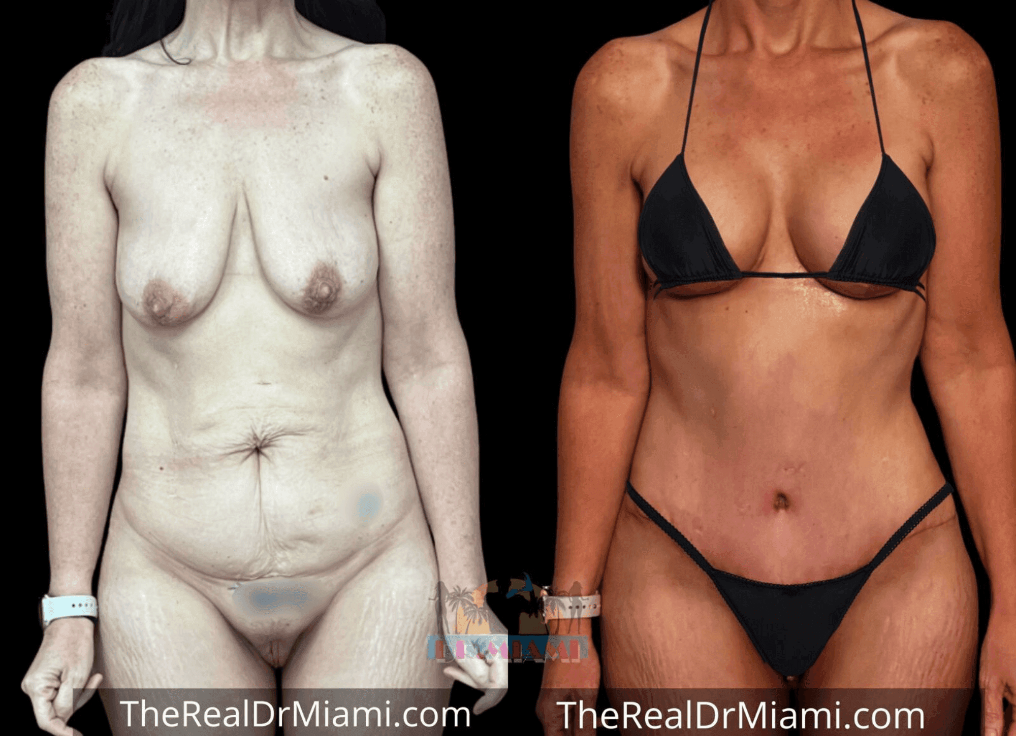 Before-and-after views for Mommy Makeover, Case 32.
