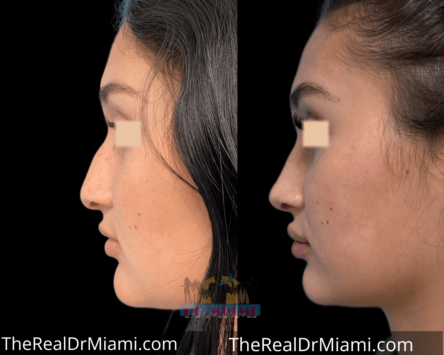 Before-and-after views for Rhinoplasty, Case 18.