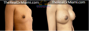 Before-and-after views for Breast Augmentation, Case 37.