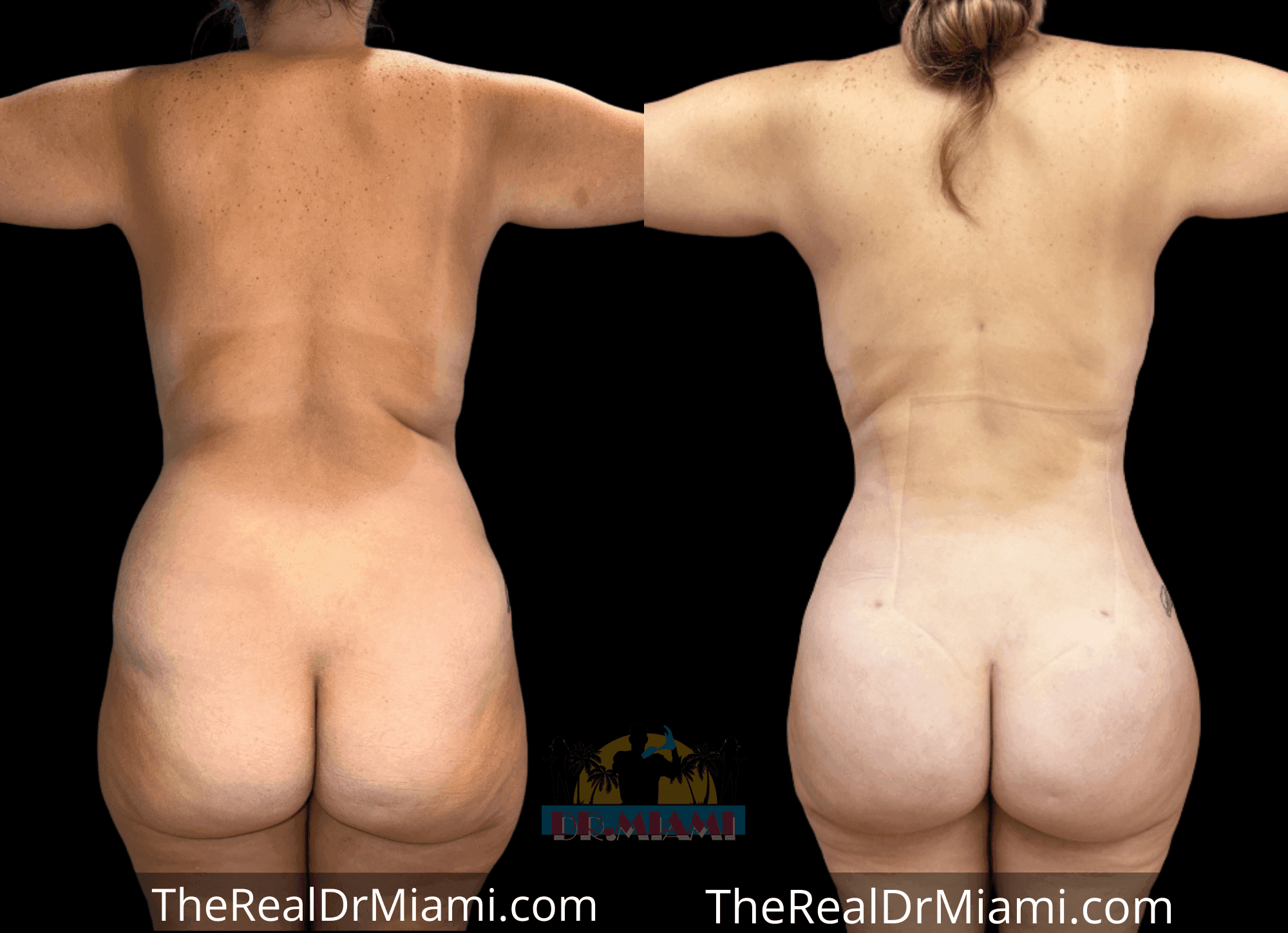 Before-and-after views for Brazilian Butt Lift, Case 31.