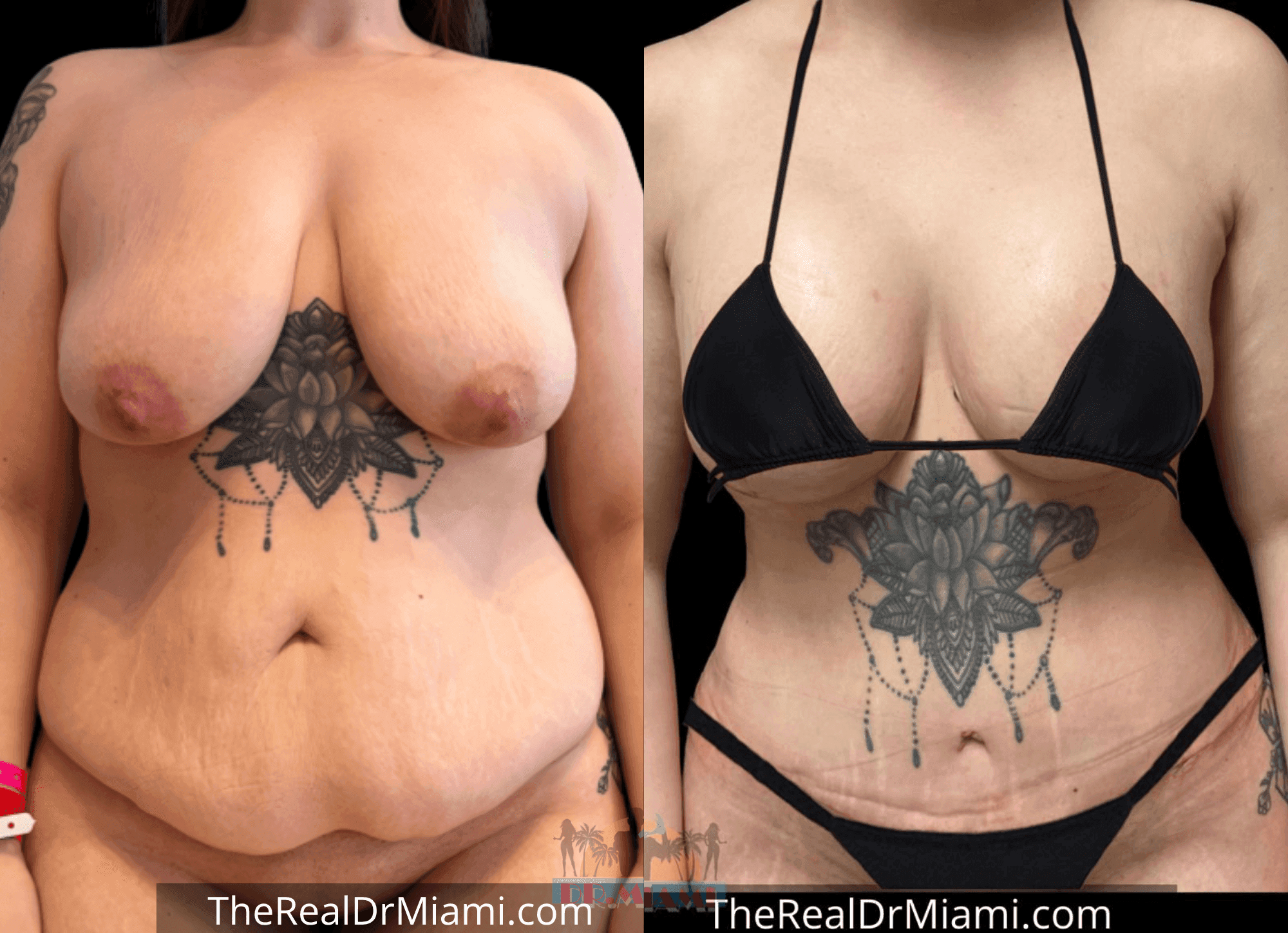 Before-and-after views for Tummy Tuck, Case 17.