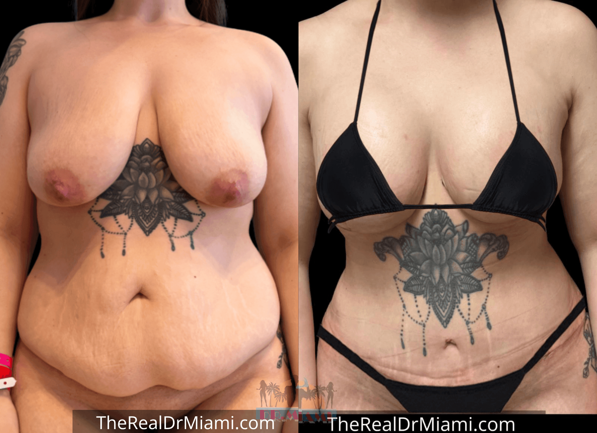 Before-and-after views for Tummy Tuck, Case 17.