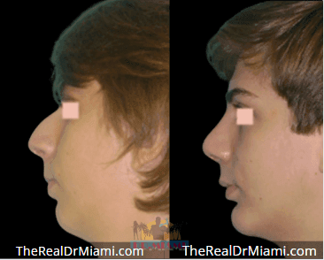 Before-and-after views for Rhinoplasty, Case 87.