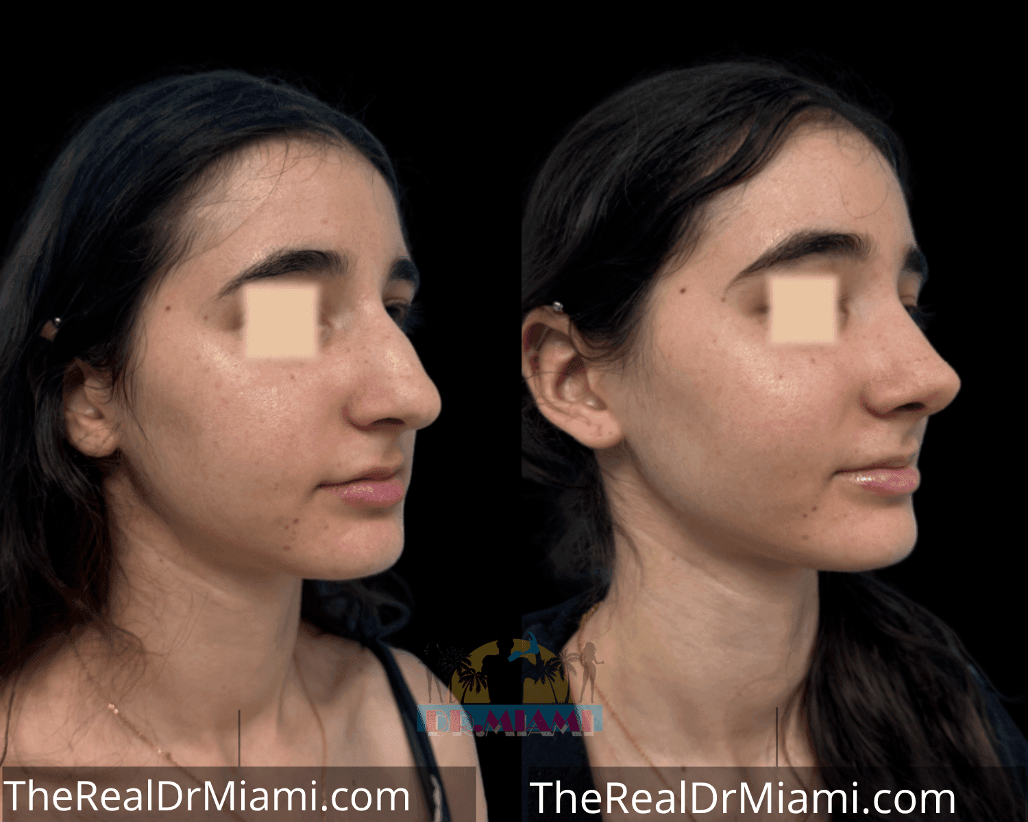 Before-and-after views for Rhinoplasty, Case 17.