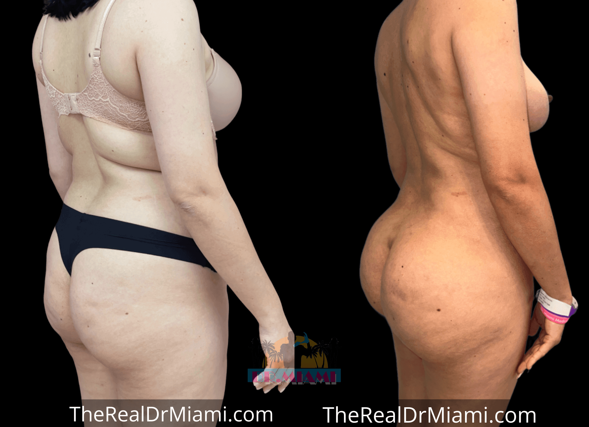 Before-and-after views for Brazilian Butt Lift, Case 17.