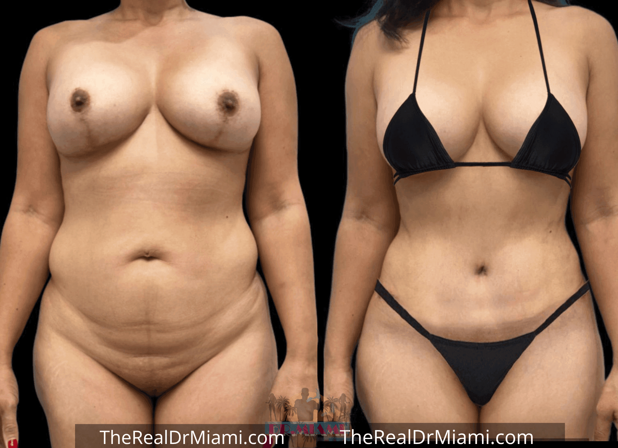 Before-and-after views for Tummy Tuck, Case 11.