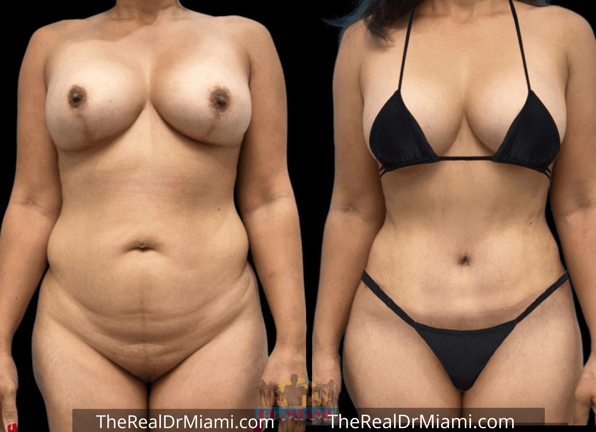 Before-and-after views for Tummy Tuck, Case 11.