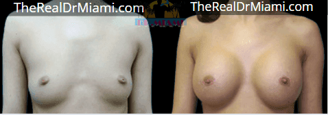Before-and-after views for Breast Augmentation, Case 99.