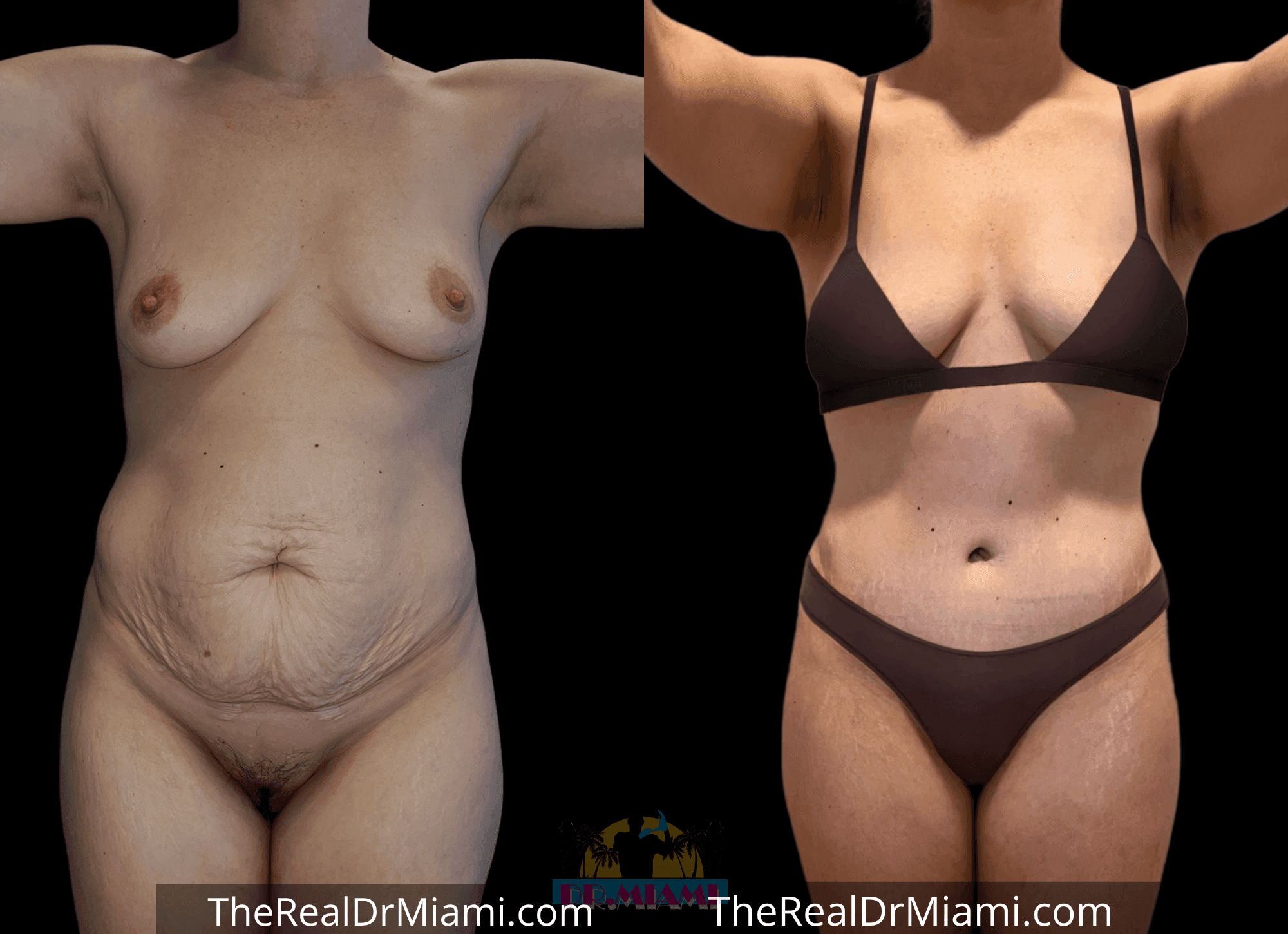 Before-and-after views for Tummy Tuck, Case 22.