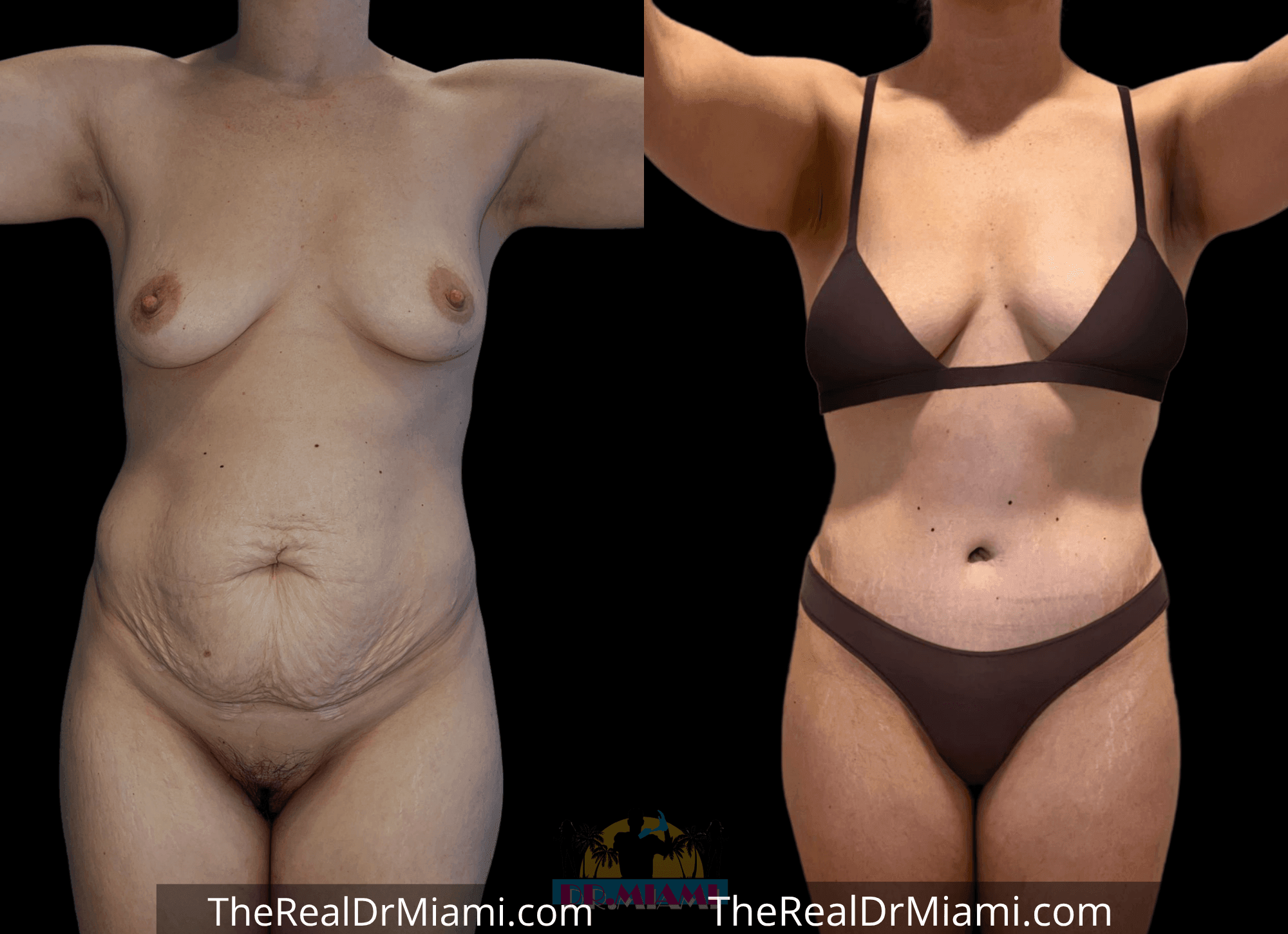 Before-and-after views for Tummy Tuck, Case 22.