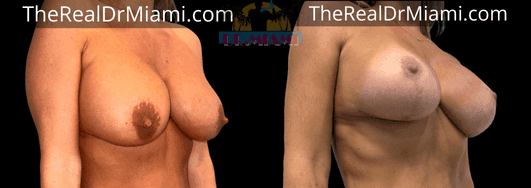 Before-and-after views for Breast Lift, Case 68.
