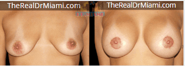 Before-and-after views for Breast Augmentation, Case 4.