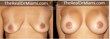 Before-and-after views for Breast Augmentation, Case 4.