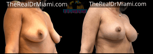 Before-and-after views for Breast Lift, Case 81.