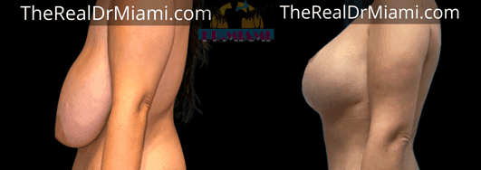 Before-and-after views for Breast Lift, Case 72.