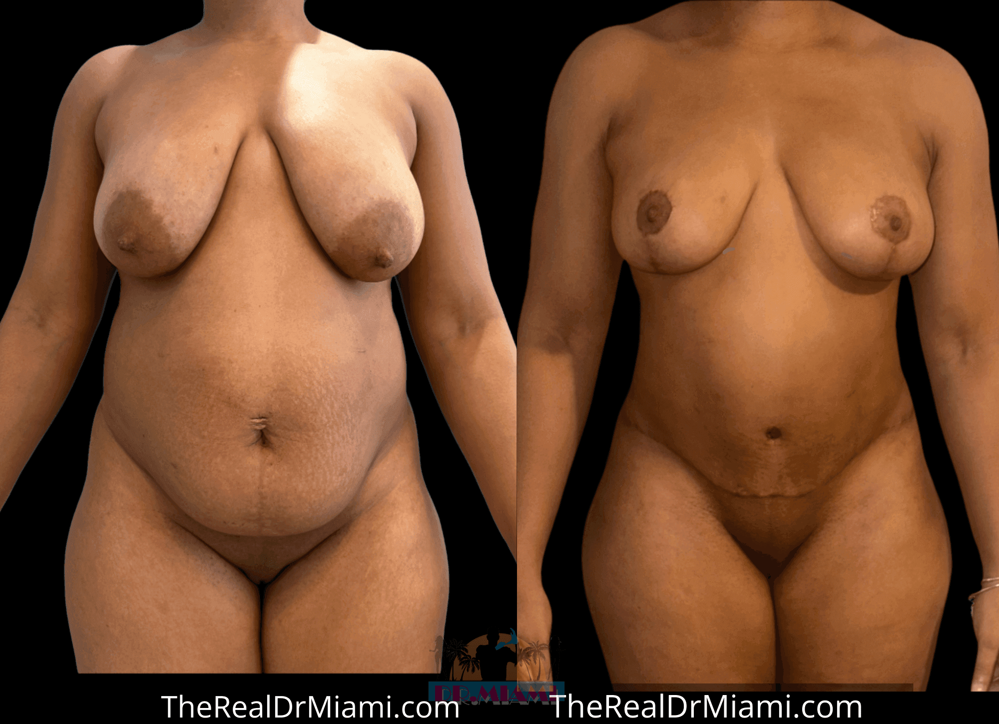 Before-and-after views for Mommy Makeover, Case 122.