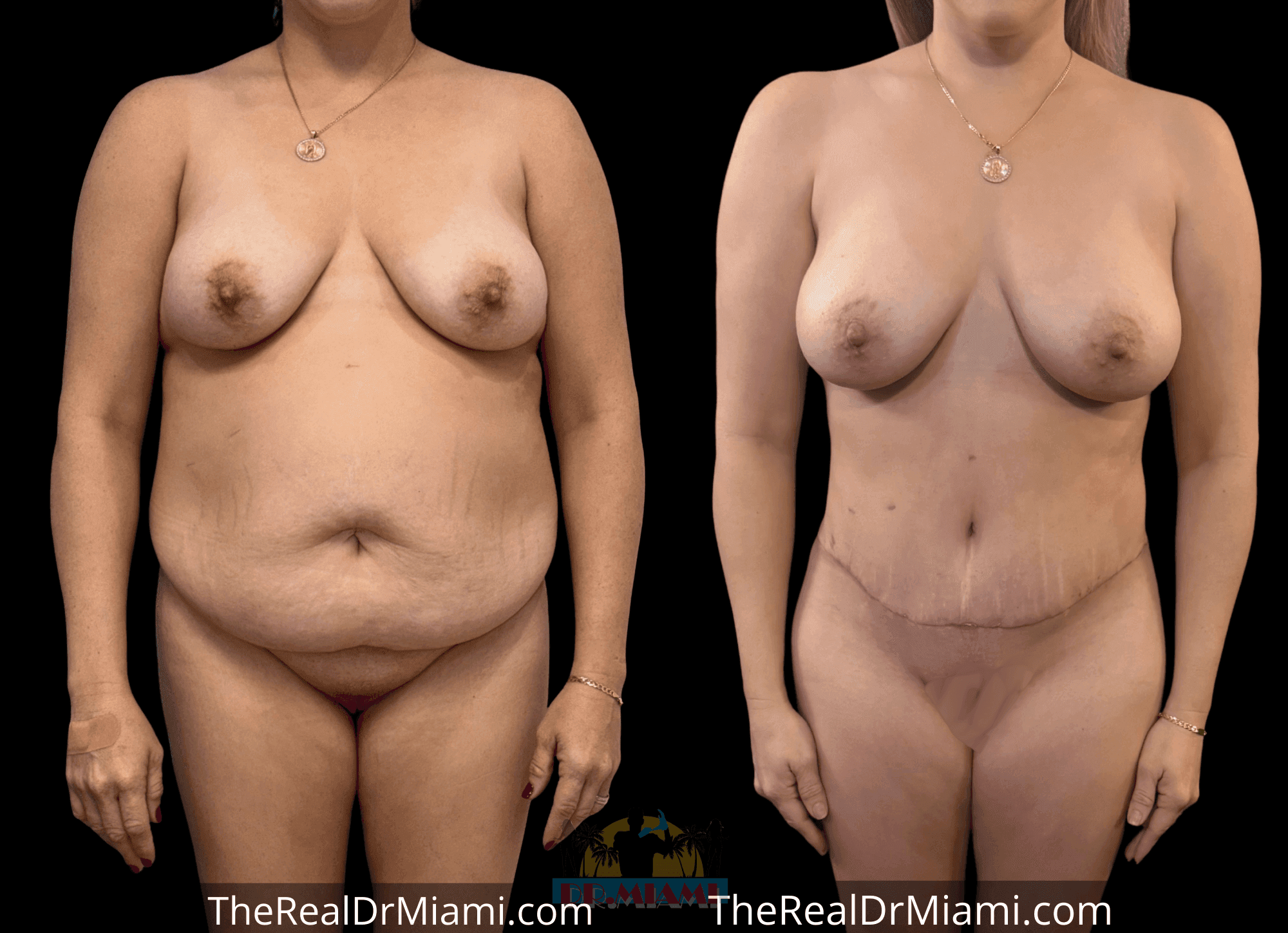Before-and-after views for Tummy Tuck, Case 108.