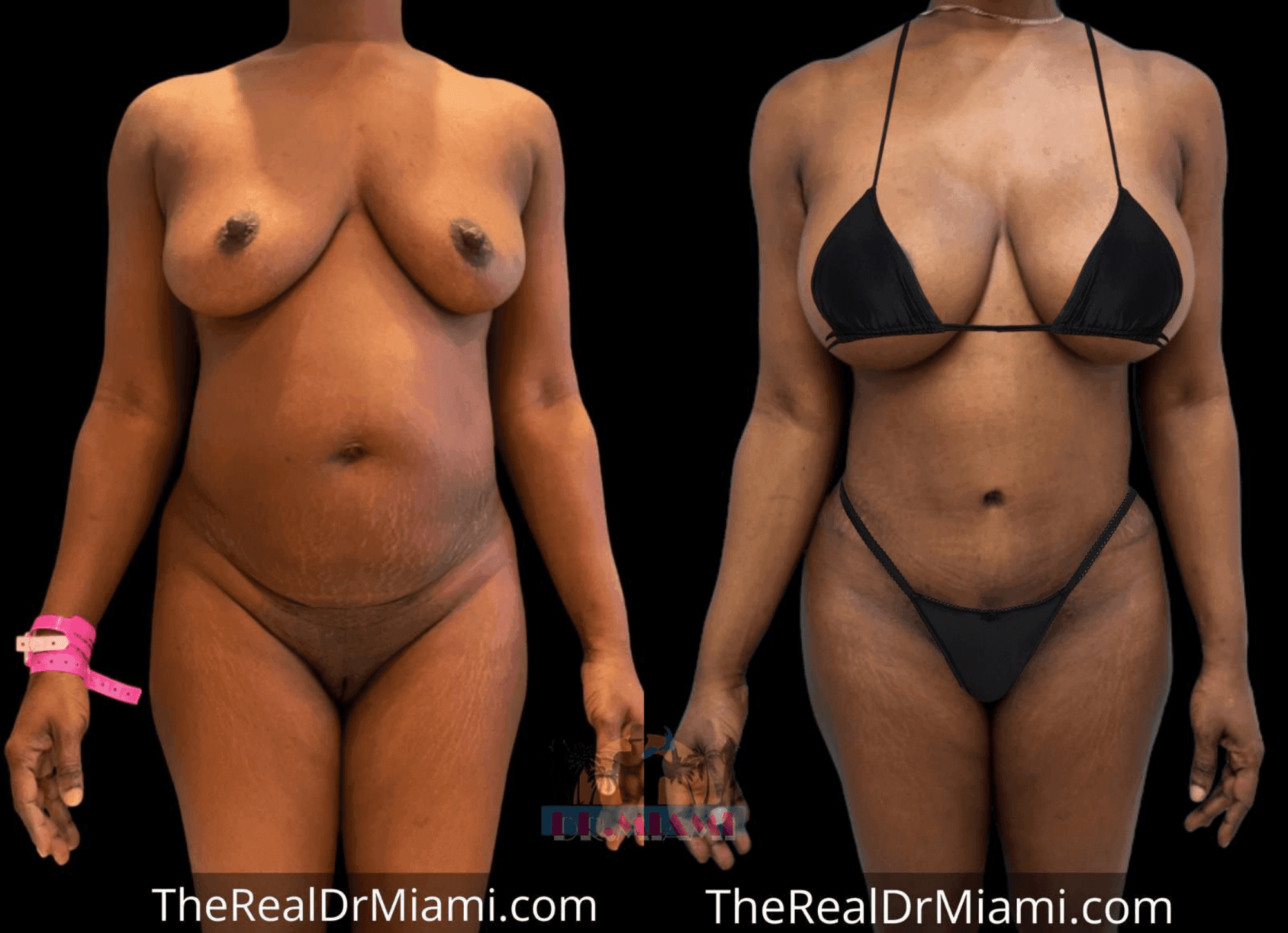 Before-and-after views for Mommy Makeover, Case 5.