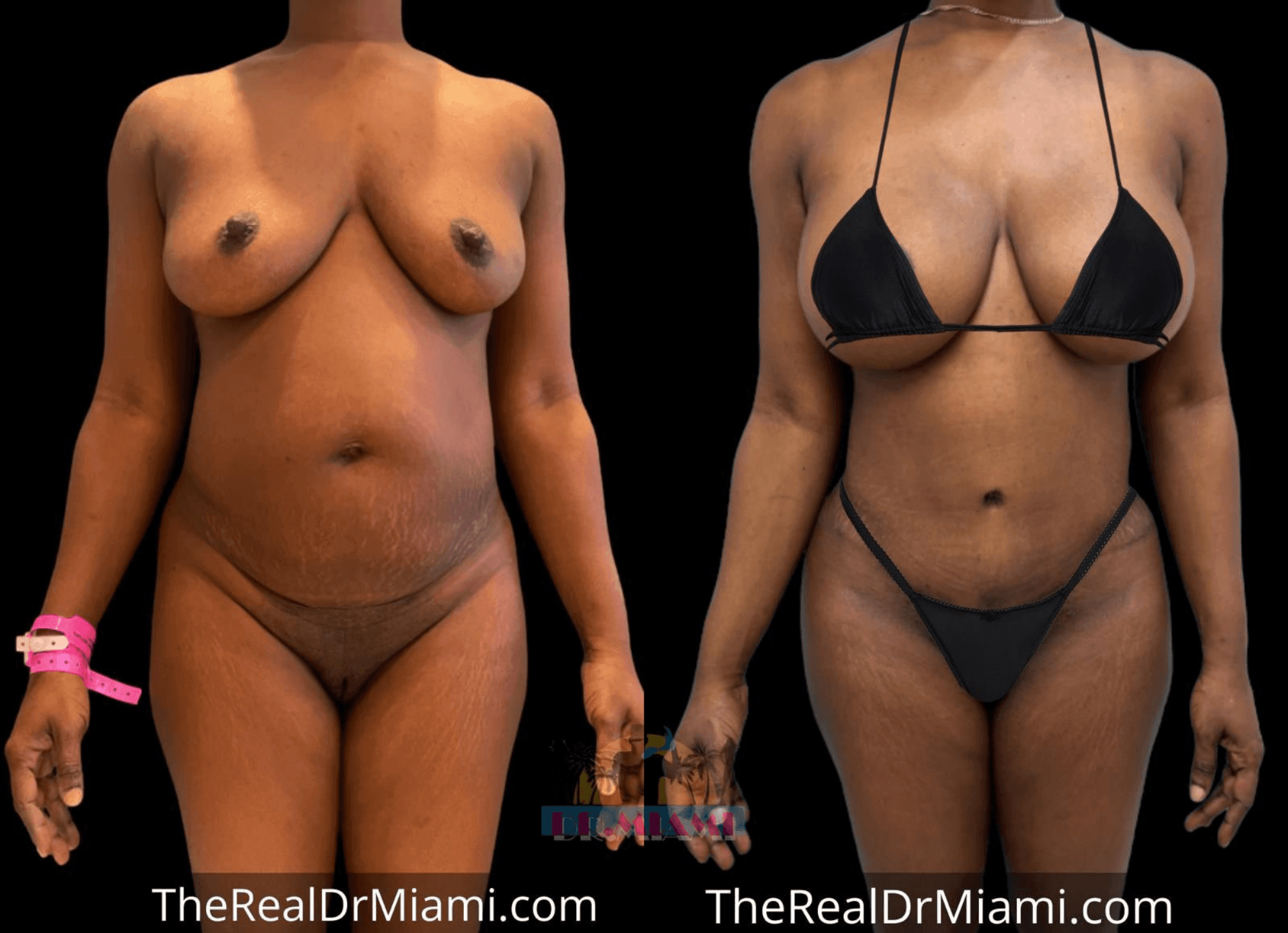 Before-and-after views for Mommy Makeover, Case 5.
