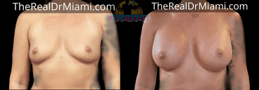 Before-and-after views for Breast Augmentation, Case 85.