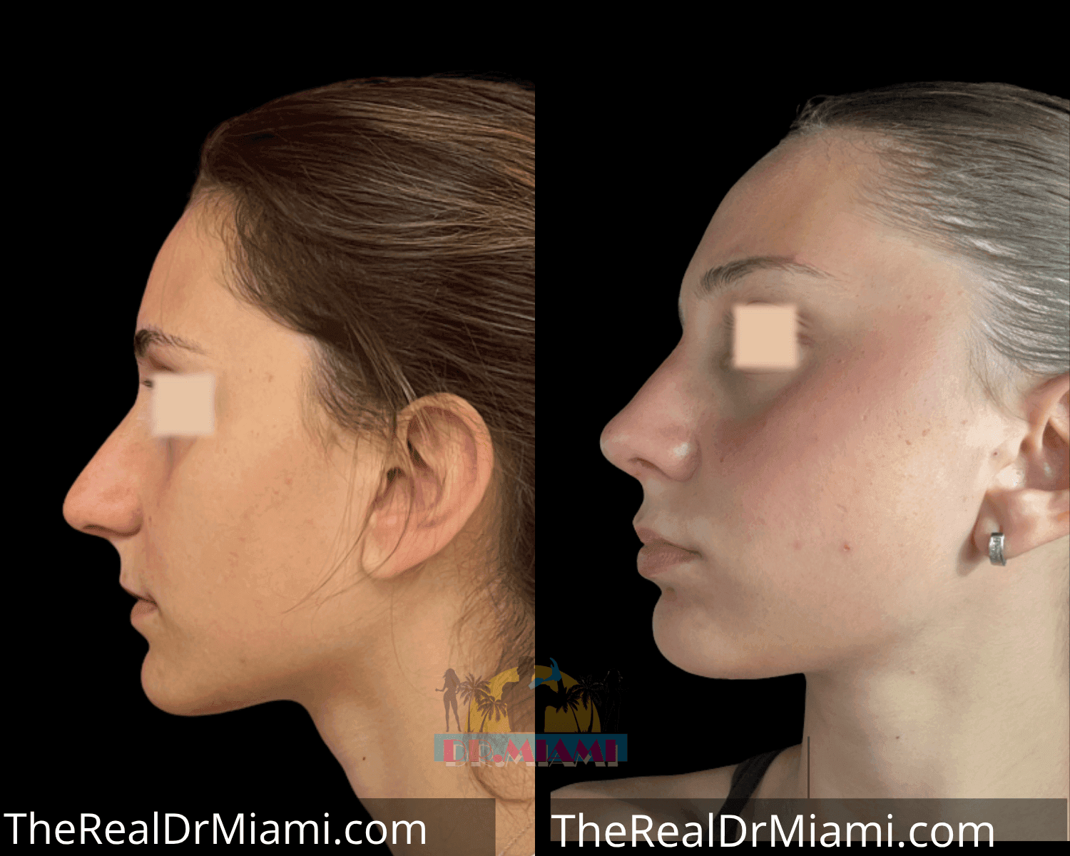Before-and-after views for Rhinoplasty, Case 10.