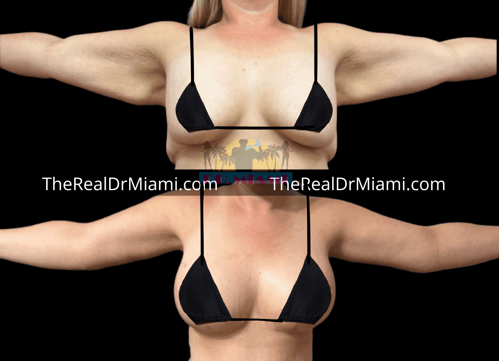 Before-and-after views for Upper Arm Lift, Case 5.