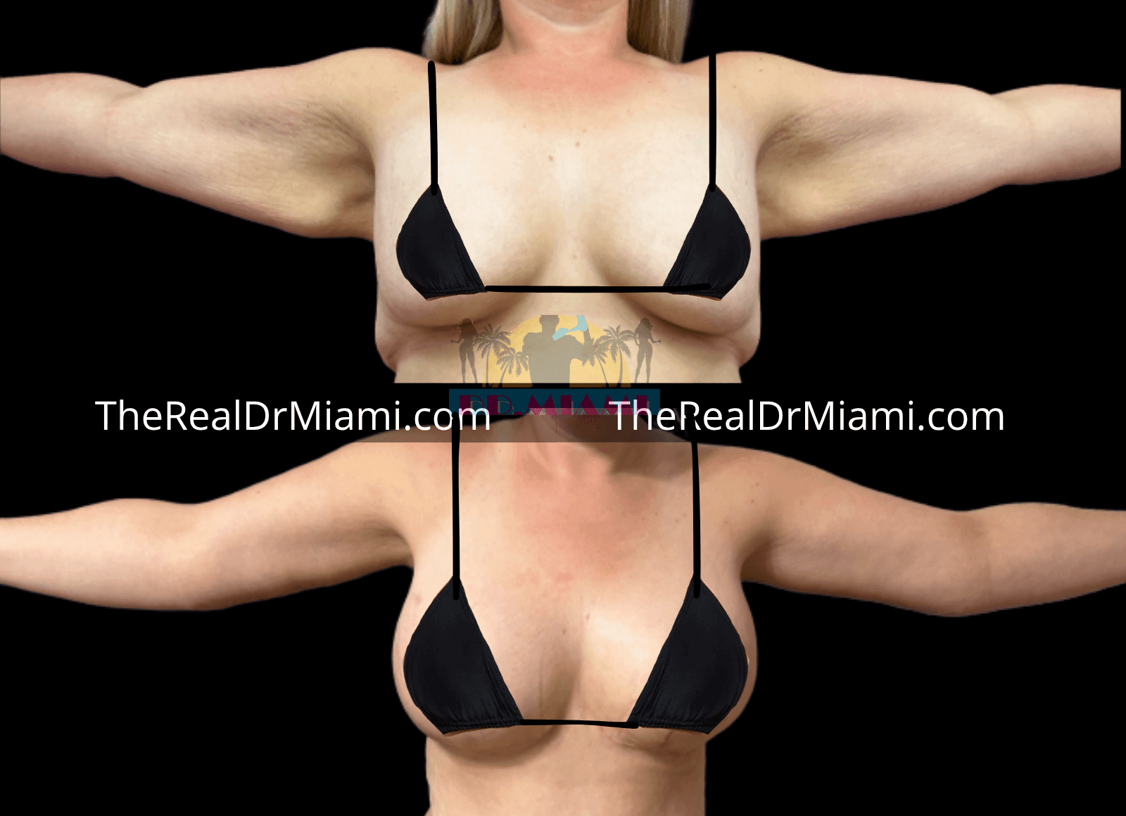 Before-and-after views for Upper Arm Lift, Case 5.