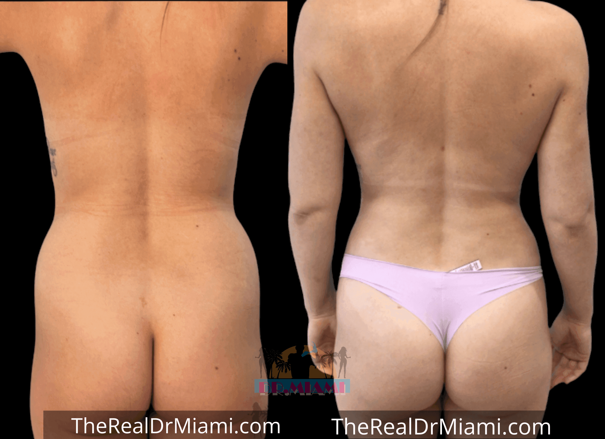 Before-and-after views for Brazilian Butt Lift, Case 82.