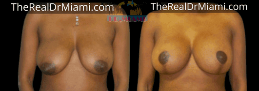 Before-and-after views for Breast Lift, Case 32.