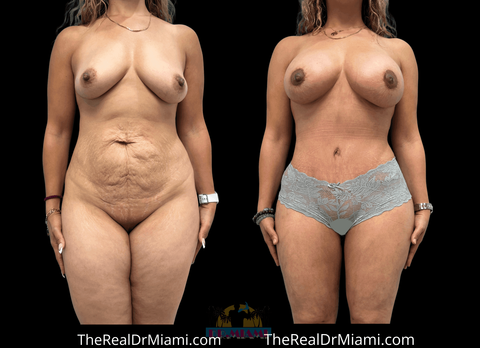 Before-and-after views for Mommy Makeover, Case 116.