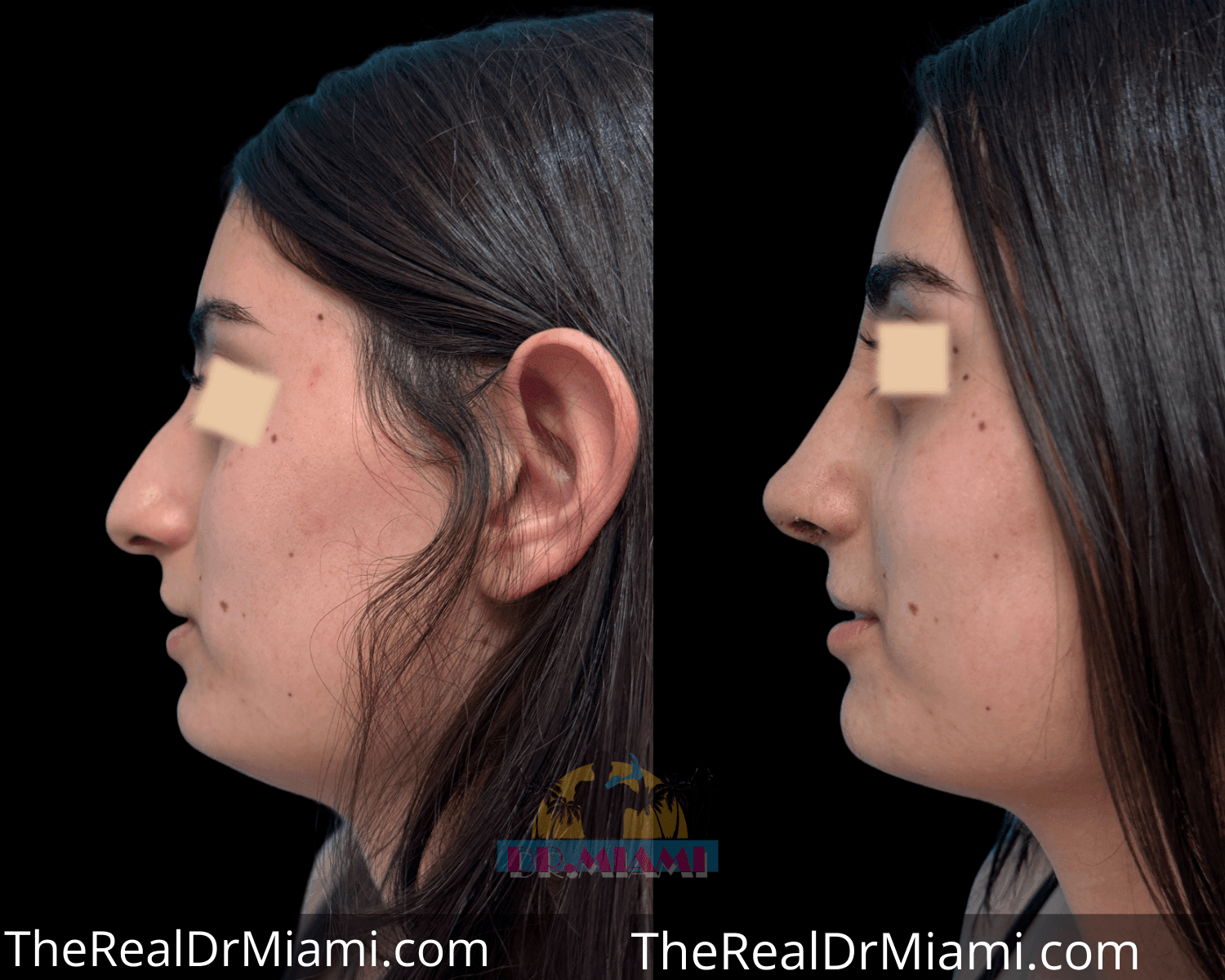 Before-and-after views for Rhinoplasty, Case 22.