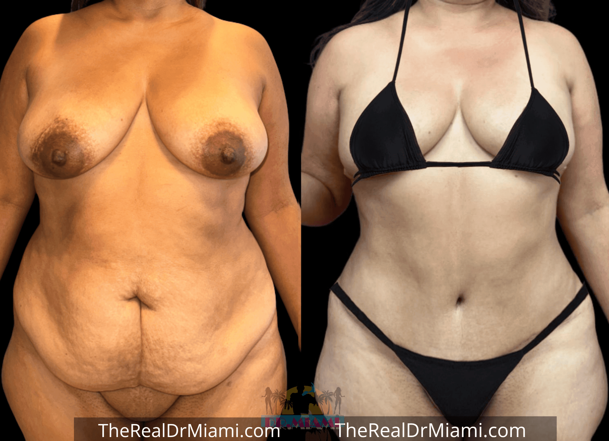 Before-and-after views for Tummy Tuck, Case 6.