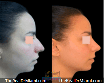 Before-and-after views for Rhinoplasty, Case 72.