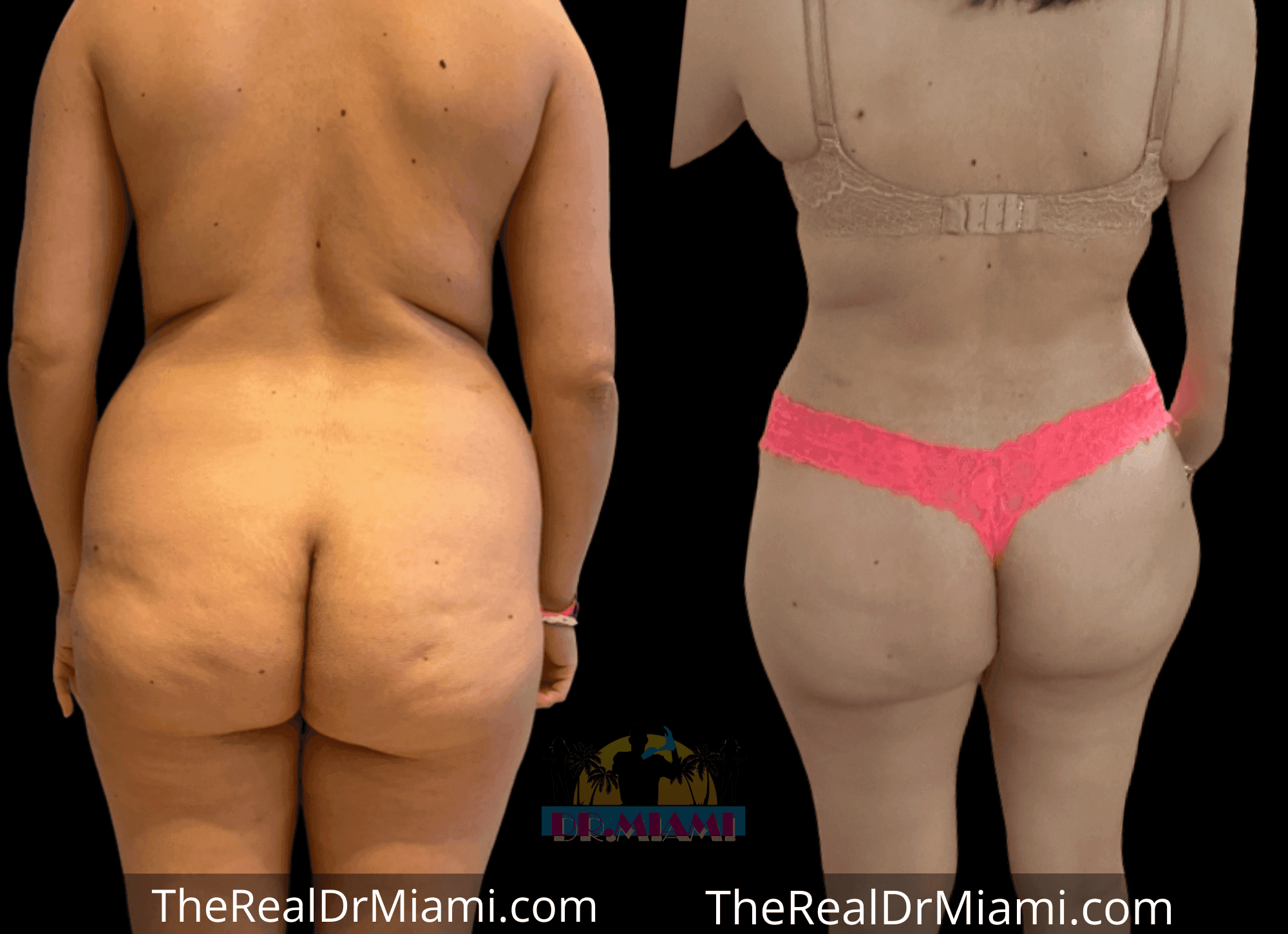 Before-and-after views for Brazilian Butt Lift, Case 15.