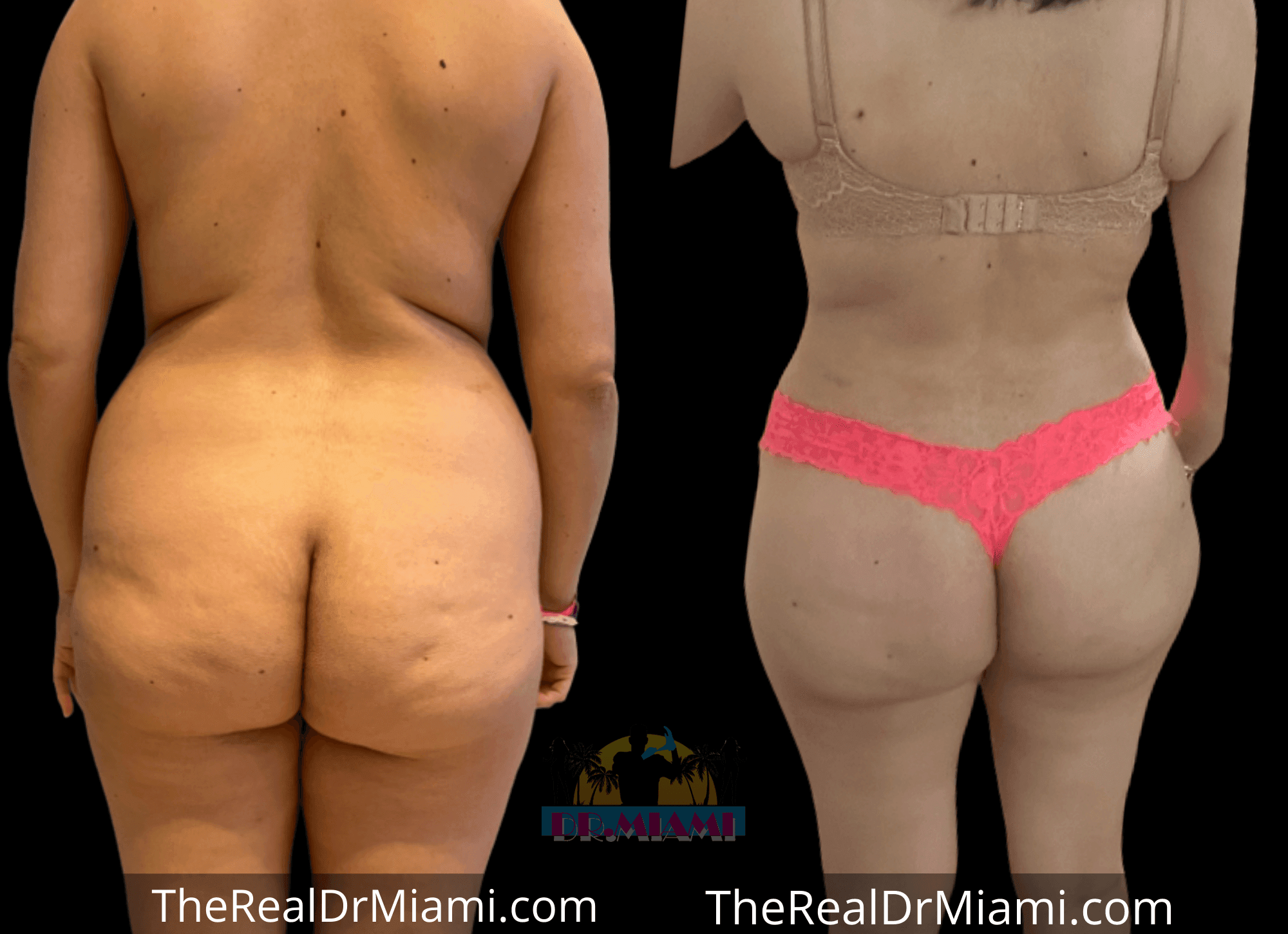 Before-and-after views for Brazilian Butt Lift, Case 15.