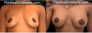 Before-and-after views for Breast Augmentation, Case 59.