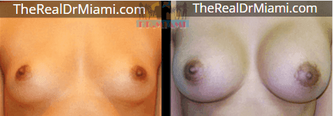 Before-and-after views for Breast Augmentation, Case 111.