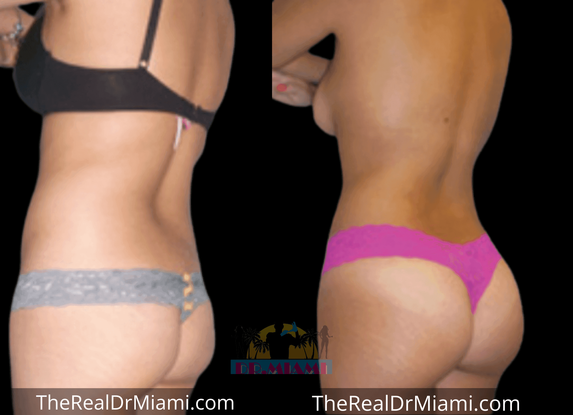 Before-and-after views for Brazilian Butt Lift, Case 3.