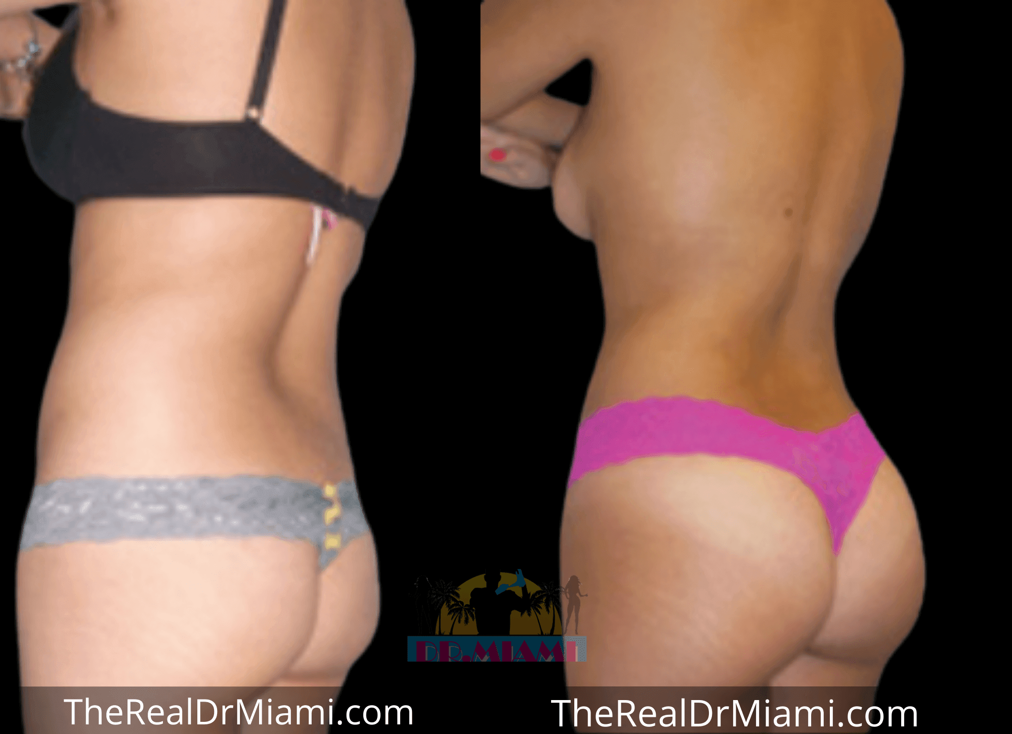 Before-and-after views for Brazilian Butt Lift, Case 3.