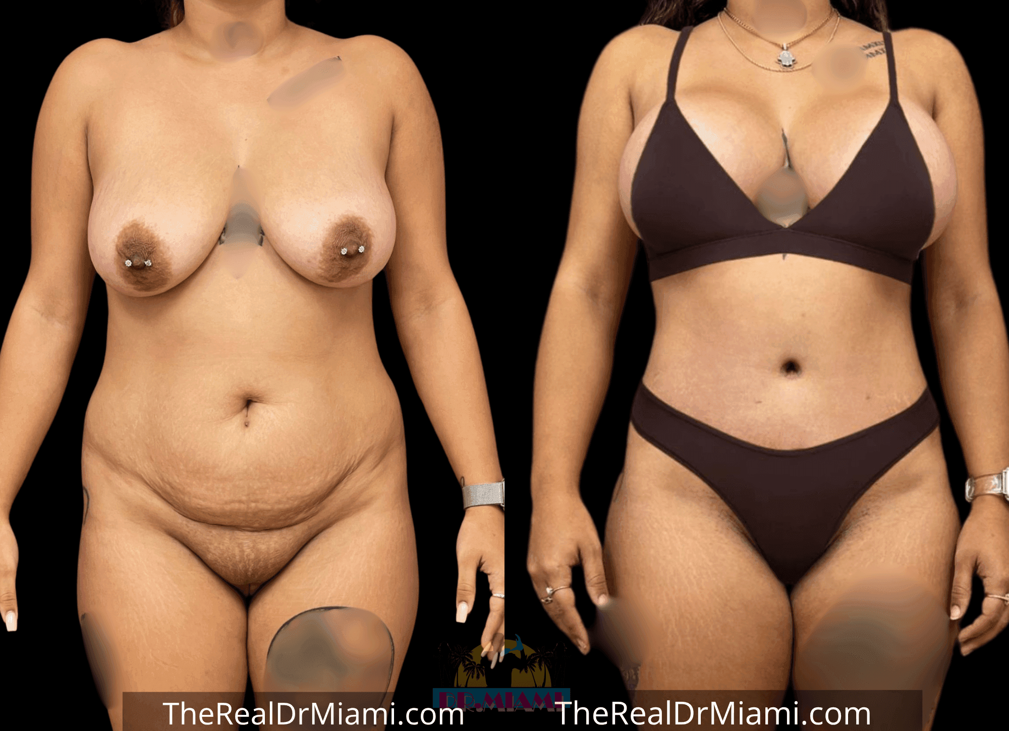 Before-and-after views for Tummy Tuck, Case 45.