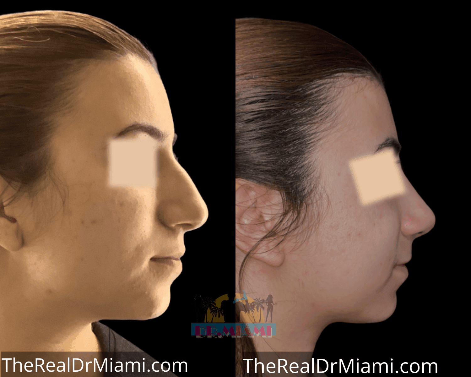 Before-and-after views for Rhinoplasty, Case 46.