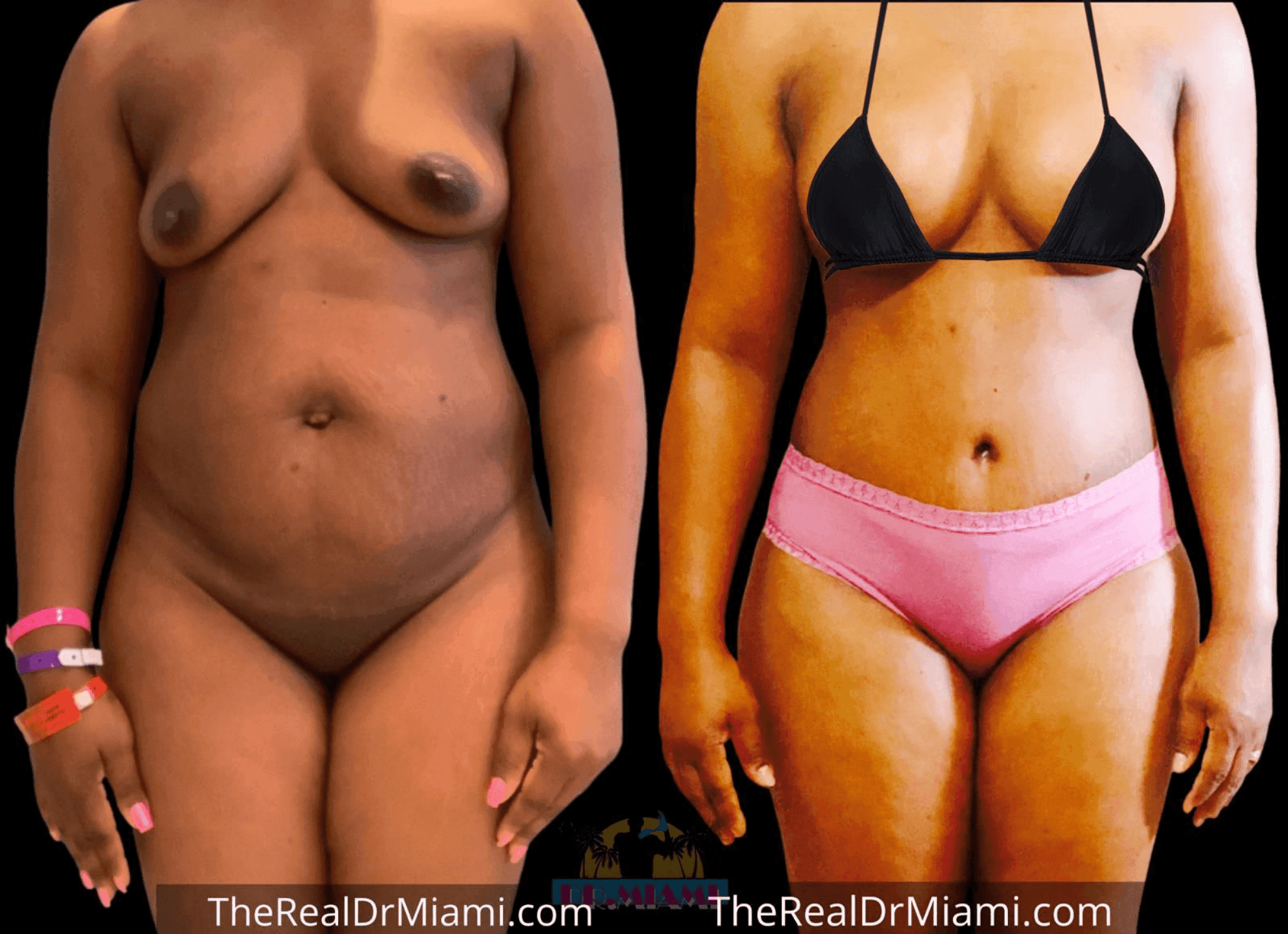 Before-and-after views for Tummy Tuck, Case 26.