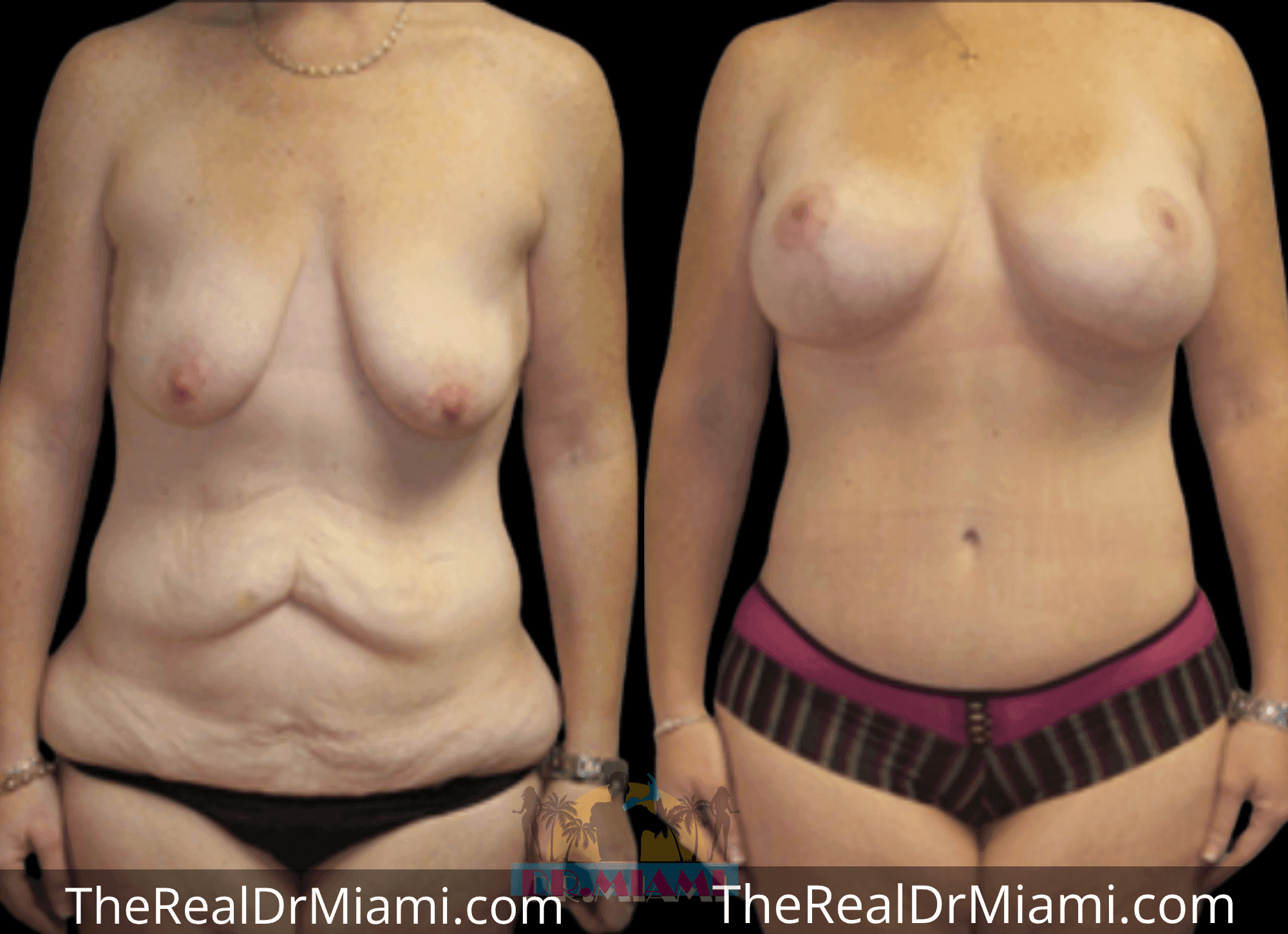Before-and-after views for Massive Weight Loss, Case 15.