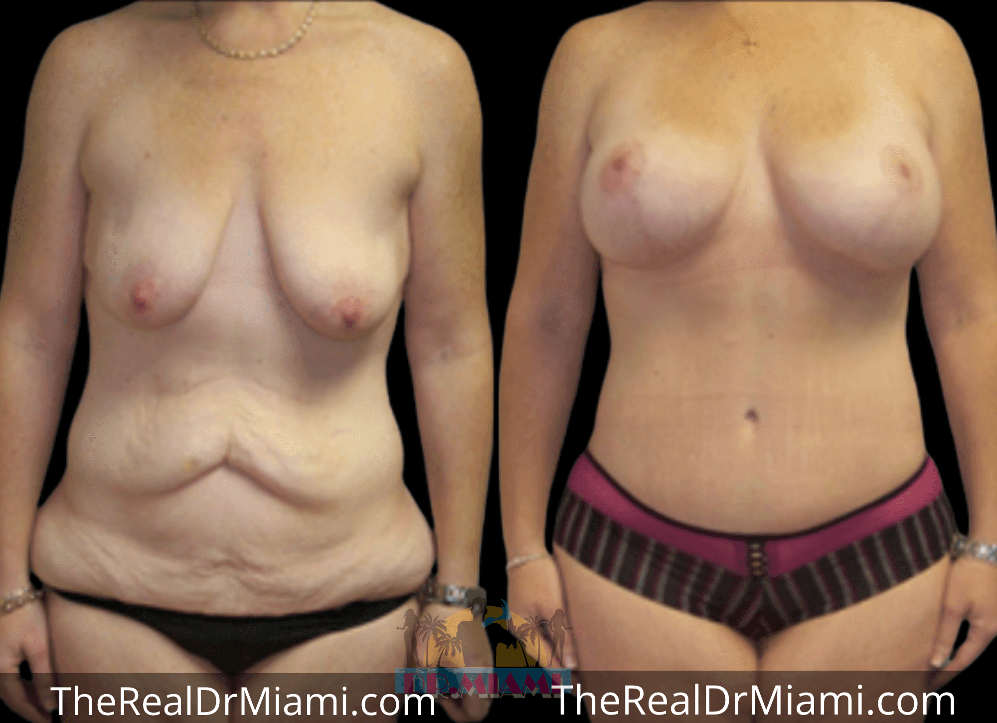 Before-and-after views for Massive Weight Loss, Case 15.