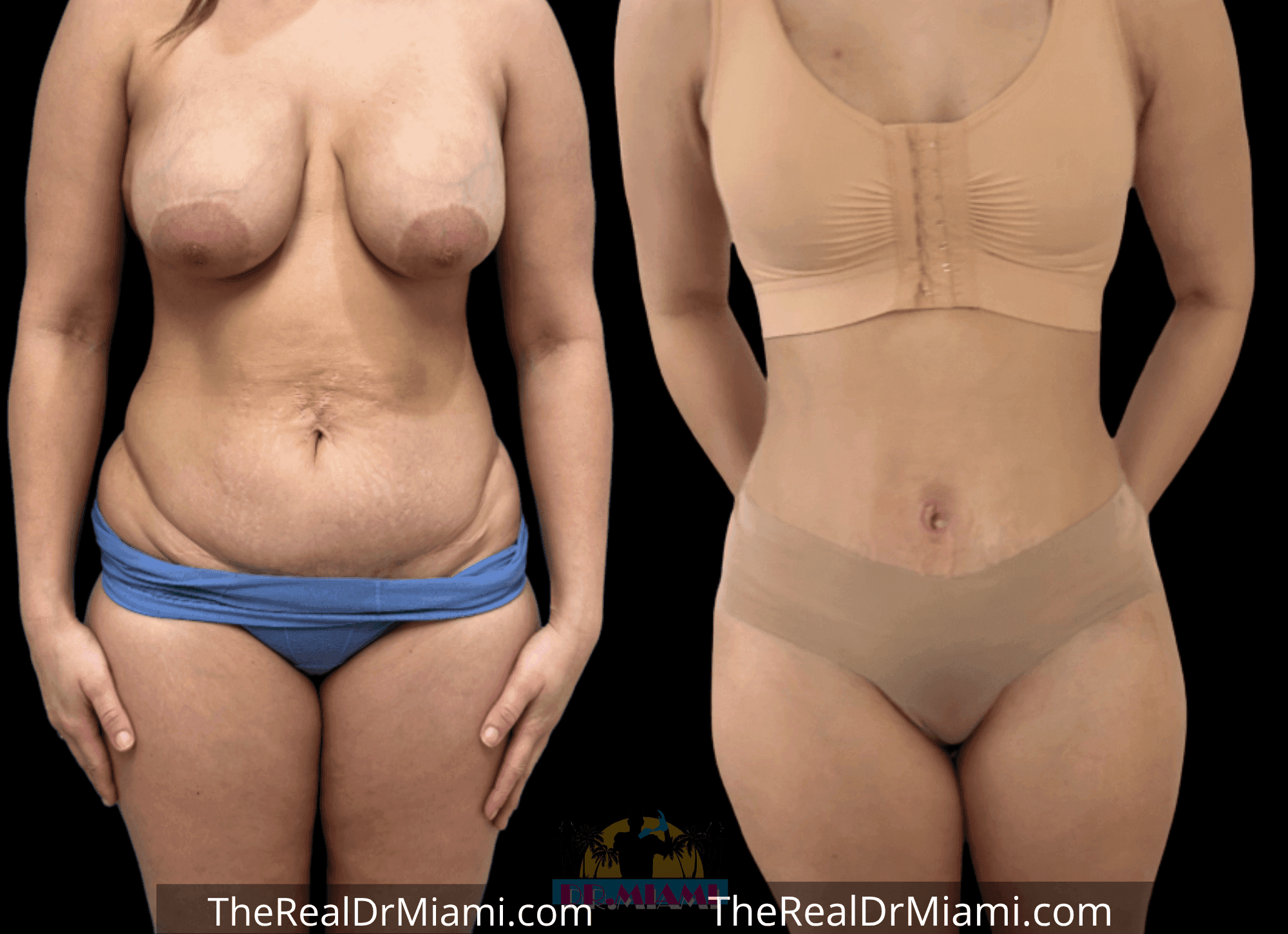 Before-and-after views for Tummy Tuck, Case 35.