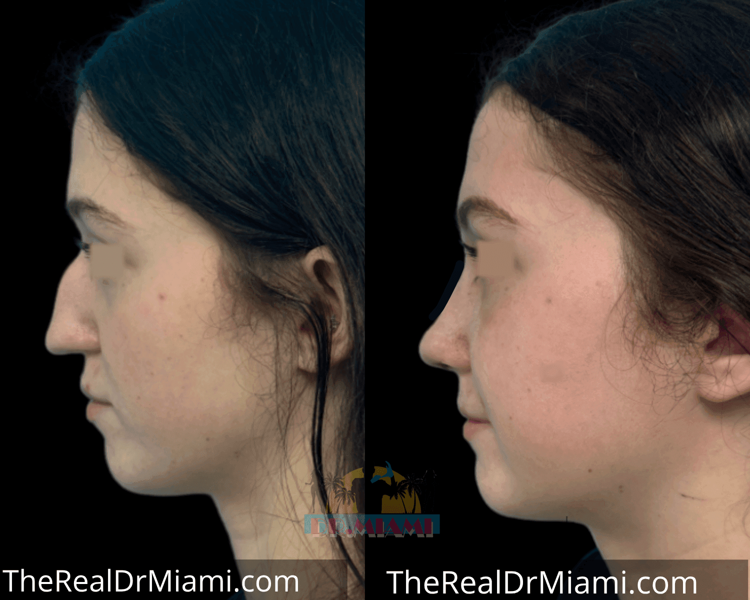 Before-and-after views for Rhinoplasty, Case 29.