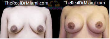 Before-and-after views for Breast Augmentation, Case 28.