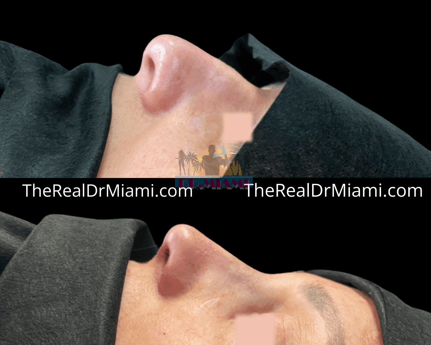 Before-and-after views for Rhinoplasty, Case 5.